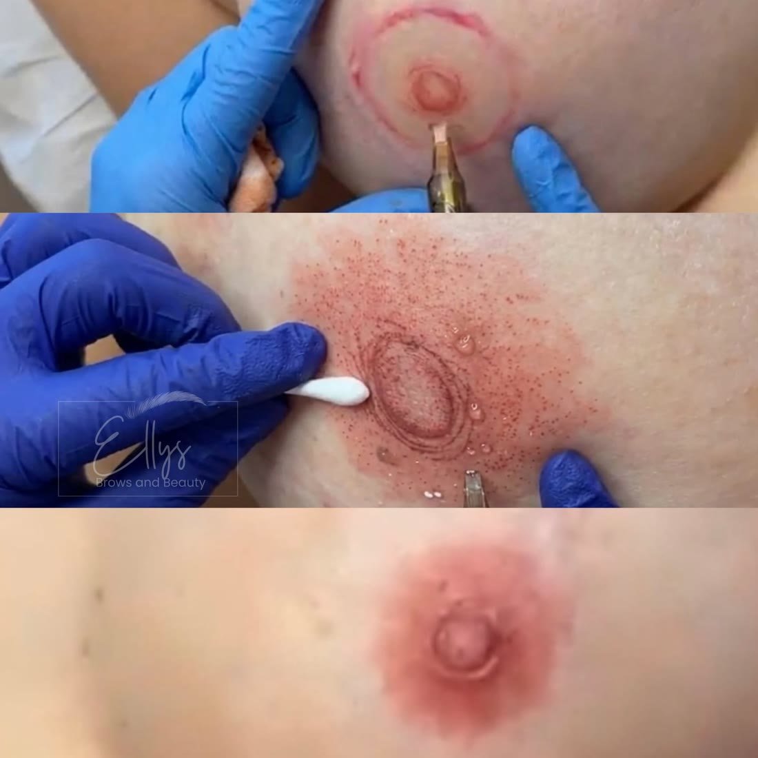 Areola Paramedical Tattoo